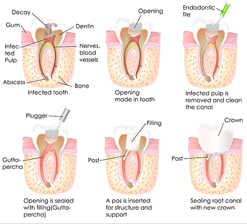 Rochester Hills Root Canal